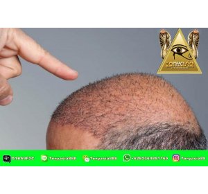 How Men Overcome Baldness Permanently | Sport Betting | Online Sport Betting